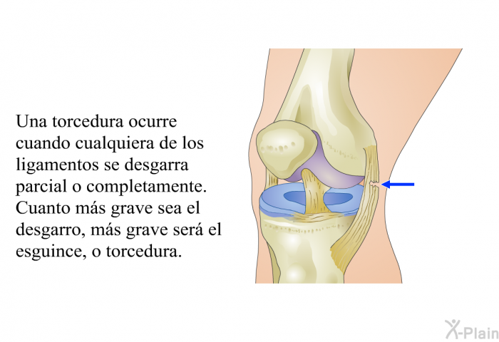 Una torcedura ocurre cuando cualquiera de los ligamentos se desgarra parcial o completamente. Cuanto ms grave sea el desgarro, ms grave ser el esguince, o torcedura.