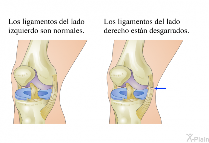 Los ligamentos del lado izquierdo son normales. Los ligamentos del lado derecho estn desgarrados.