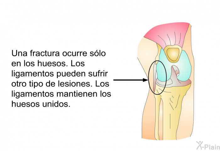 Una fractura ocurre slo en los huesos. Los ligamentos pueden sufrir otro tipo de lesiones. Los ligamentos mantienen los huesos unidos.