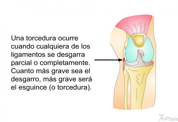 Una torcedura ocurre cuando cualquiera de los ligamentos se desgarra parcial o completamente. Cuanto ms grave sea el desgarro, ms grave ser el esguince (o torcedura).