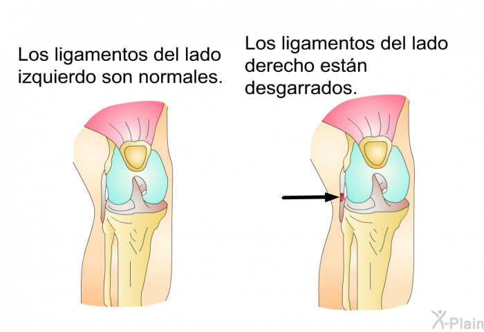 Los ligamentos del lado izquierdo son normales. Los ligamentos del lado derecho estn desgarrados.