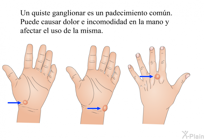 Un quiste ganglionar es un padecimiento comn. Puede causar dolor e incomodidad en la mano y afectar el uso de la misma.