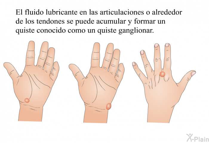 El fluido lubricante en las articulaciones o alrededor de los tendones se puede acumular y formar un quiste conocido como un quiste ganglionar.