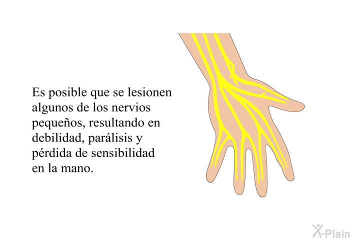 Es posible que se lesionen algunos de los nervios pequeos, resultando en debilidad, parlisis y prdida de sensibilidad en la mano.