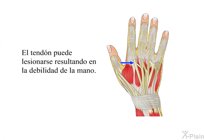 El tendn puede lesionarse resultando en la debilidad de la mano.