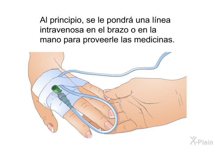 Al principio, se le pondr una lnea intravenosa en el brazo o en la mano para proveerle las medicinas.