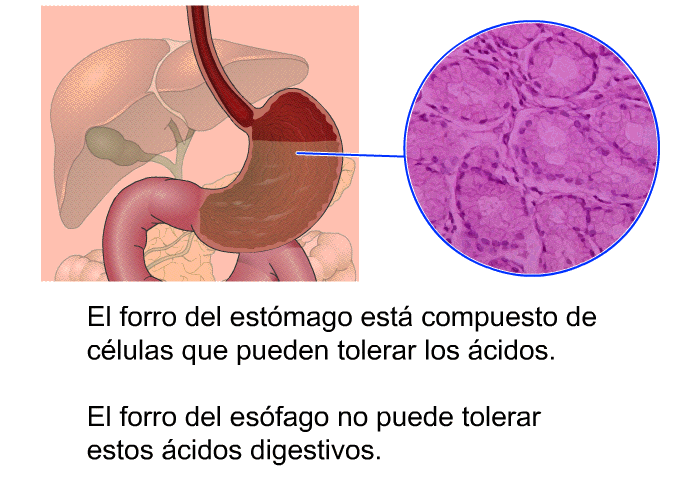 El forro del estmago est compuesto de clulas que pueden tolerar los cidos. El forro del esfago no puede tolerar estos cidos digestivos.