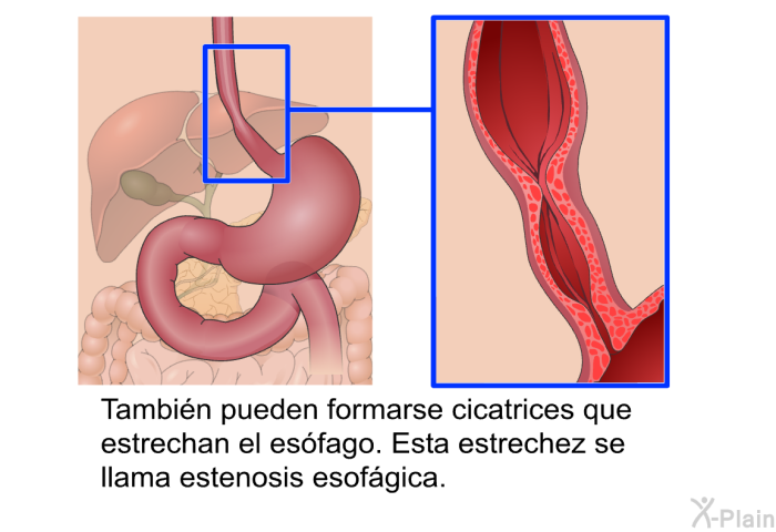 Tambi�n pueden formarse cicatrices que estrechan el es�fago. Esta estrechez se llama estenosis esof�gica.