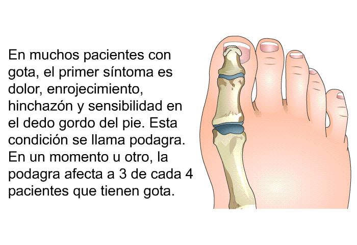 En muchos pacientes con gota, el primer s�ntoma es dolor, enrojecimiento, hinchaz�n y sensibilidad en el dedo gordo del pie. Esta condici�n se llama <I>podagra</I>. En un momento u otro, la podagra afecta a 3 de cada 4 pacientes que tienen gota.