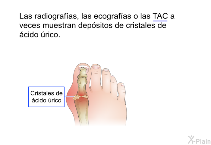 Las radiografas, las ecografas o las TAC a veces muestran depsitos de cristales de cido rico.