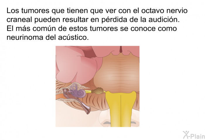 Los tumores que tienen que ver con el octavo nervio craneal pueden resultar en prdida de la audicin. El ms comn de estos tumores se conoce como neurinoma del acstico.