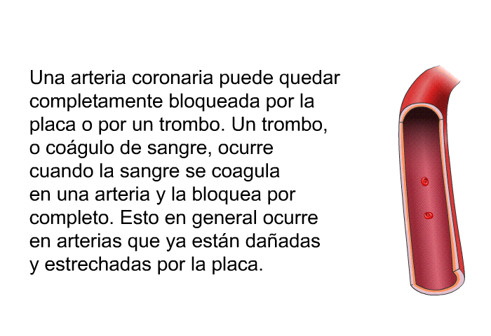 Una arteria coronaria puede quedar completamente bloqueada por la placa o por un trombo. Un trombo, o co�gulo de sangre, ocurre cuando la sangre se coagula en una arteria y la bloquea por completo. Esto en general ocurre en arterias que ya est�n da�adas y estrechadas por la placa.