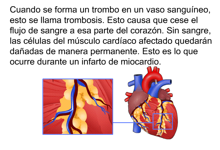 Cuando se forma un trombo en un vaso sangu�neo, esto se llama trombosis. Esto causa que cese el flujo de sangre a esa parte del coraz�n. Sin sangre, las c�lulas del m�sculo card�aco afectado quedar�n da�adas de manera permanente. Esto es lo que ocurre durante un infarto de miocardio.