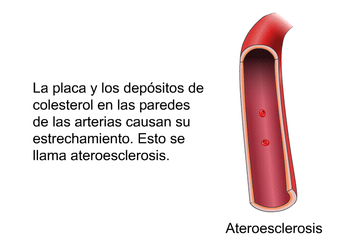 La placa y los depsitos de colesterol en las paredes de las arterias causan su estrechamiento. Esto se llama ateroesclerosis.