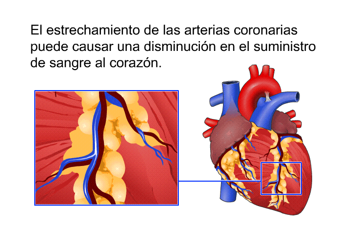El estrechamiento de las arterias coronarias puede causar una disminucin en el suministro de sangre al corazn.