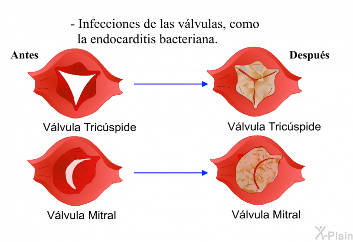 Infecciones de las vlvulas, como la endocarditis bacteriana.