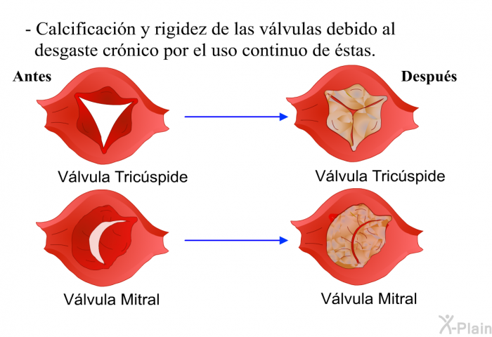 Calcificacin y rigidez de las vlvulas debido al desgaste crnico por el uso continuo de stas.