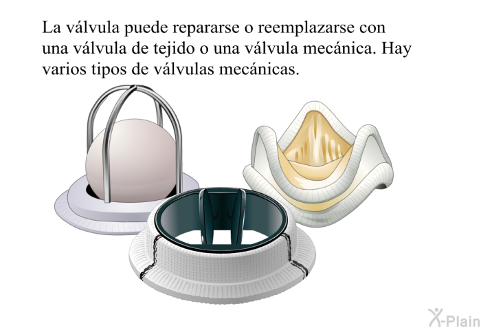 La vlvula puede repararse o reemplazarse con una vlvula de tejido o una vlvula mecnica. Hay varios tipos de vlvulas mecnicas.