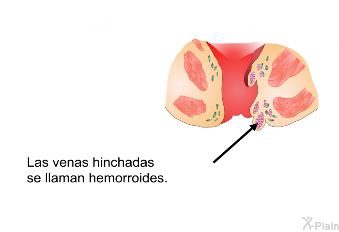 Las venas hinchadas se llaman hemorroides.