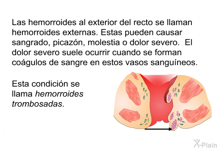 Las hemorroides al exterior del recto se llaman hemorroides externas. Estas pueden causar sangrado, picazn, molestia o dolor severo. El dolor severo suele ocurrir cuando se forman cogulos de sangre en estos vasos sanguneos. Esta condicin se llama <I>hemorroides trombosadas.</I>