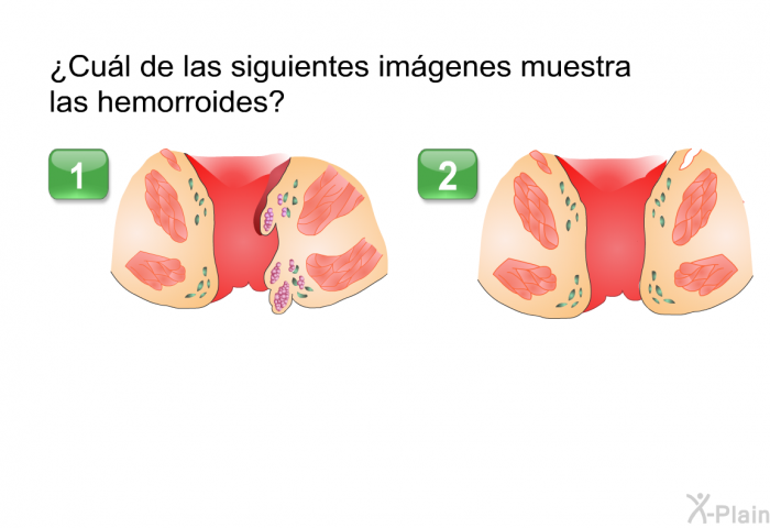 ¿Cul de las siguientes imgenes muestra las hemorroides?
