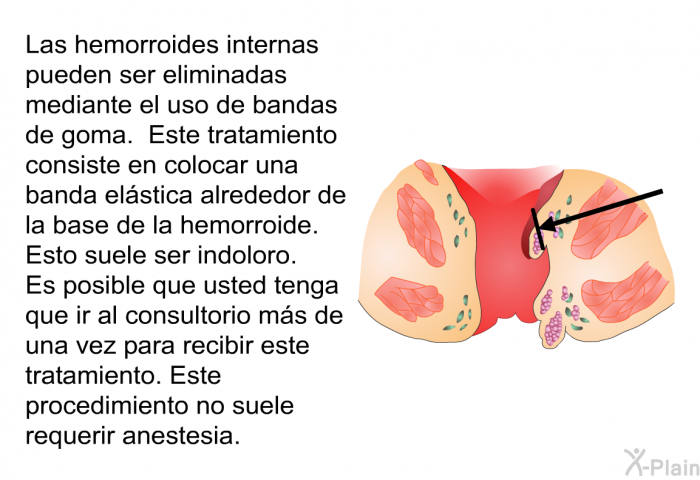 Las hemorroides internas pueden ser eliminadas mediante el uso de bandas de goma. Este tratamiento consiste en colocar una banda elstica alrededor de la base de la hemorroide. Esto suele ser indoloro. Es posible que usted tenga que ir al consultorio ms de una vez para recibir este tratamiento. Este procedimiento no suele requerir anestesia.
