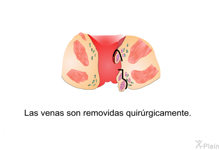 Las venas son removidas quirrgicamente.
