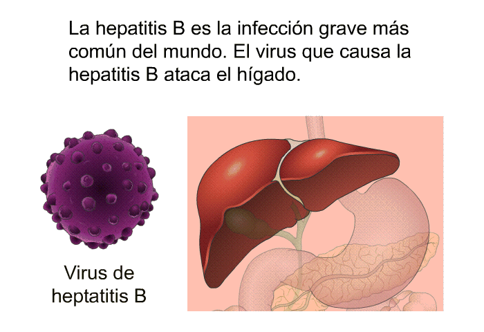 La hepatitis B es la infeccin grave ms comn del mundo. El virus que causa la hepatitis B ataca el hgado.
