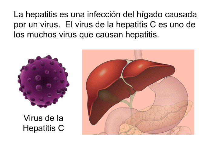 La hepatitis es una infeccin del hgado causada por un virus. El virus de la hepatitis C es uno de los muchos virus que causan hepatitis.