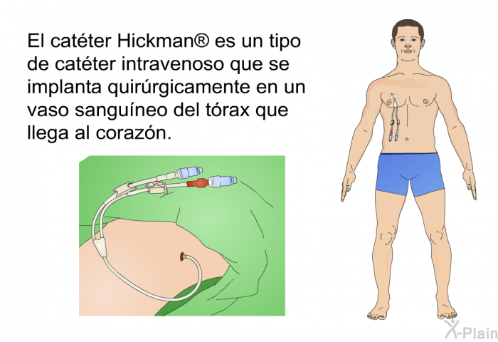 El catter Hickman  es un tipo de catter intravenoso que se implanta quirrgicamente en un vaso sanguneo del trax que llega al corazn.