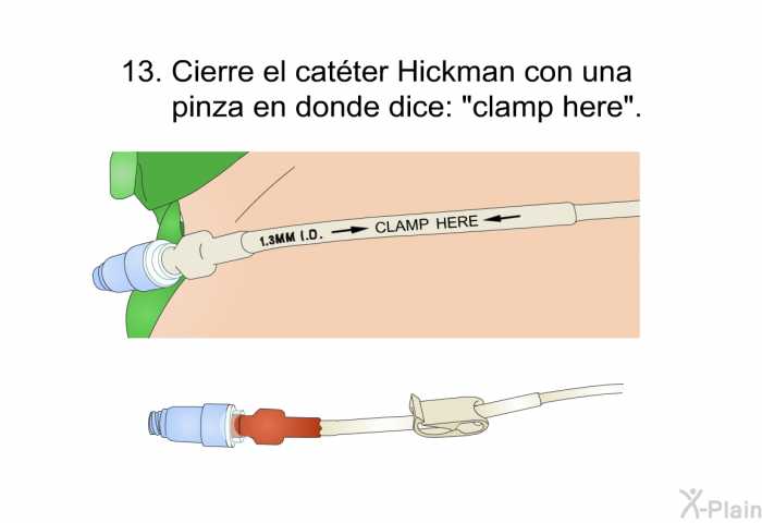 <OL START=13>  Cierre el cat�ter Hickman con una pinza en donde dice: &ldquo;clamp here&rdquo;.