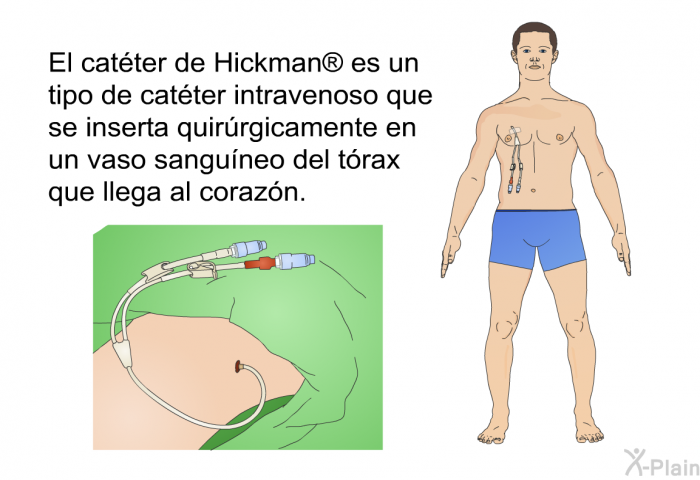 El catter de Hickman  es un tipo de catter intravenoso que se inserta quirrgicamente en un vaso sanguneo del trax que llega al corazn.