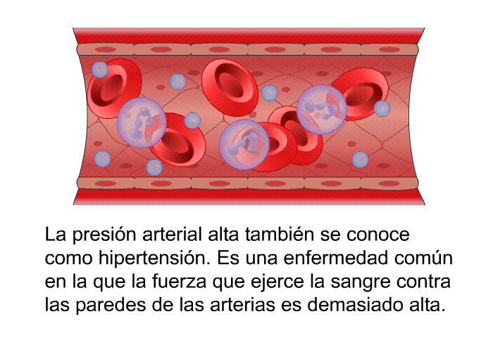 La presin arterial alta tambin se conoce como hipertensin. Es una enfermedad comn en la que la fuerza que ejerce la sangre contra las paredes de las arterias es demasiado alta.