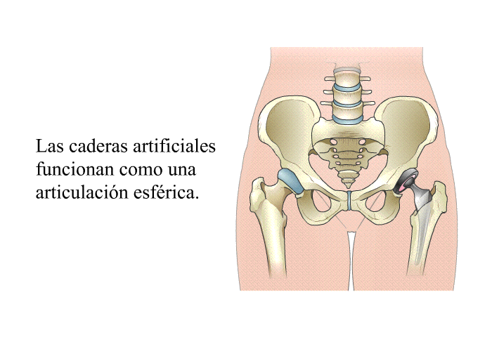 Las caderas artificiales funcionan como una articulaci�n esf�rica.
