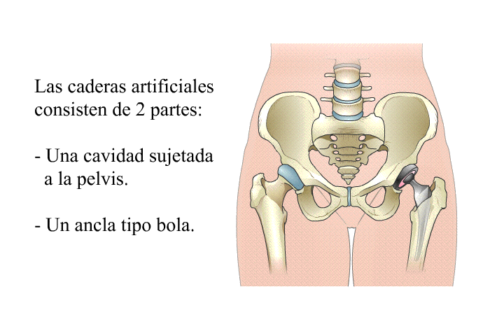 Las caderas artificiales consisten de 2 partes:  Una cavidad sujetada a la pelvis. Un ancla tipo bola.