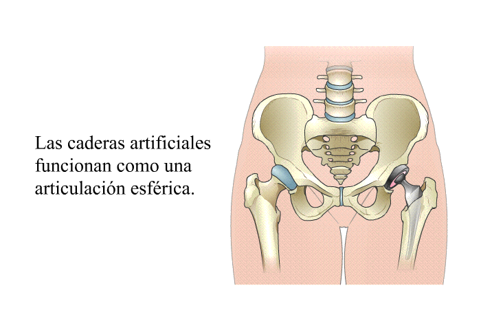 Las caderas artificiales funcionan como una articulacin esfrica.