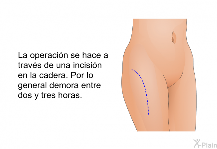 La operacin se hace a travs de una incisin en la cadera. Por lo general demora entre dos y tres horas.