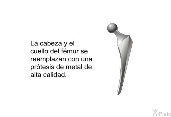 La cabeza y el cuello del fmur se reemplazan con una prtesis de metal de alta calidad.