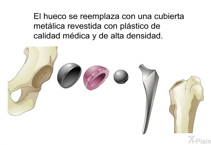 El hueco se reemplaza con una cubierta metlica revestida con plstico de calidad mdica y de alta densidad.