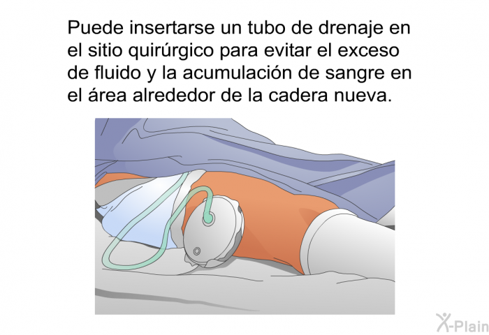 Puede insertarse un tubo de drenaje en el sitio quirrgico para evitar el exceso de fluido y la acumulacin de sangre en el rea alrededor de la cadera nueva.