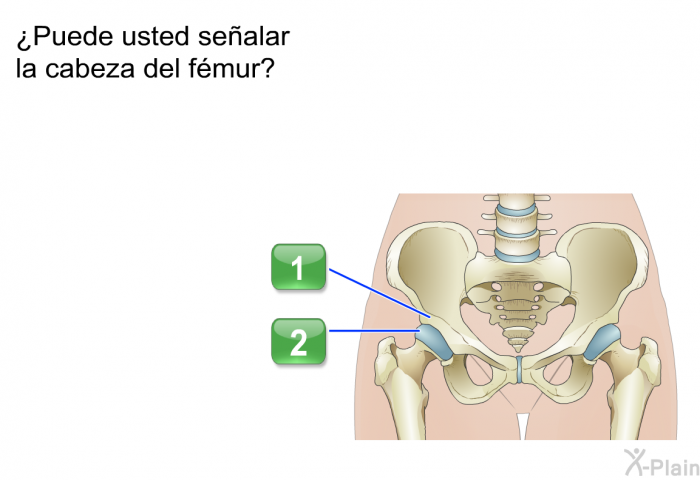 ¿Puede usted sealar la cabeza del fmur?