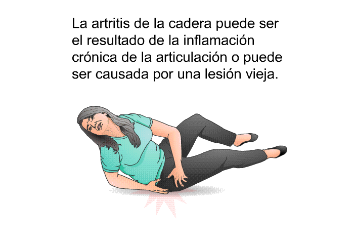 La artritis de la cadera puede ser el resultado de la inflamacin crnica de la articulacin o puede ser causada por una lesin vieja.