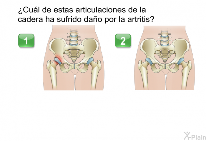 ¿Cul de estas articulaciones de la cadera ha sufrido dao por la artritis?