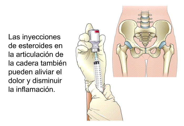 Las inyecciones de esteroides en la articulaci�n de la cadera tambi�n pueden aliviar el dolor y disminuir la inflamaci�n.