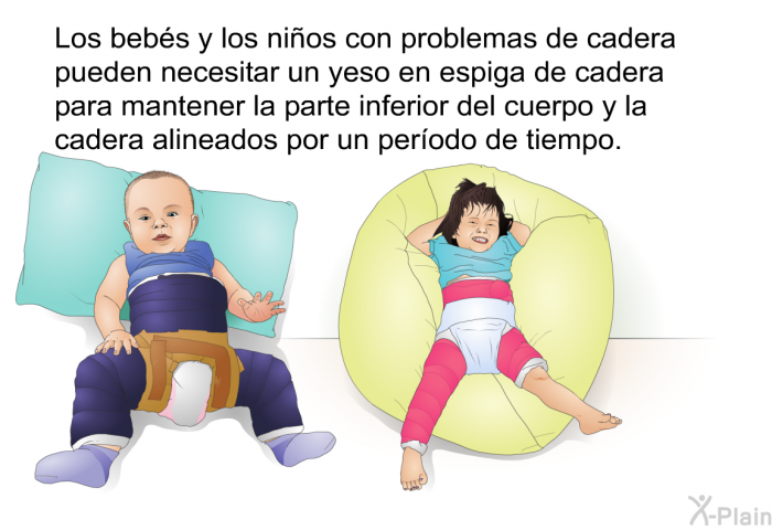 Los bebs y los nios con problemas de cadera pueden necesitar un yeso en espiga de cadera para mantener la parte inferior del cuerpo y la cadera alineados por un perodo de tiempo.
