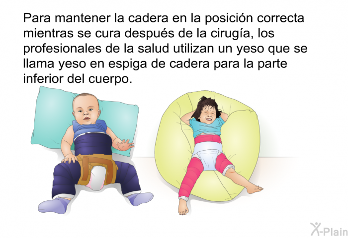 Para mantener la cadera en la posicin correcta mientras se cura despus de la ciruga, los profesionales de la salud utilizan un yeso que se llama yeso en espiga de cadera para la parte inferior del cuerpo.