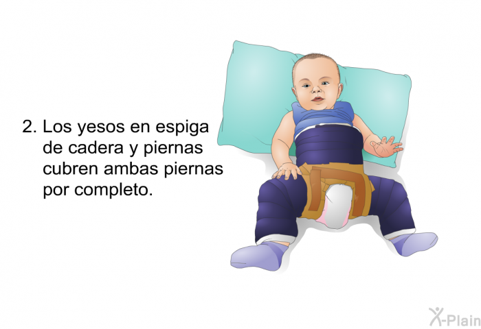 Los yesos en espiga de cadera y piernas cubren ambas piernas por completo.