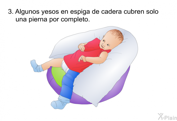 Algunos yesos en espiga de cadera cubren solo una pierna por completo.