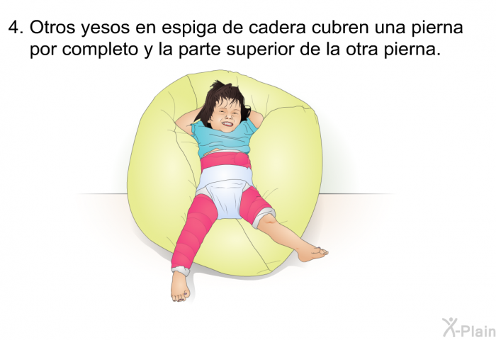 Otros yesos en espiga de cadera cubren una pierna por completo y la parte superior de la otra pierna.