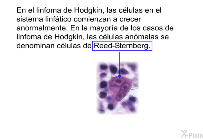 En el linfoma de Hodgkin, las clulas en el sistema linftico comienzan a crecer anormalmente. En la mayora de los casos de linfoma de Hodgkin, las clulas anmalas se denominan clulas de Reed-Sternberg.